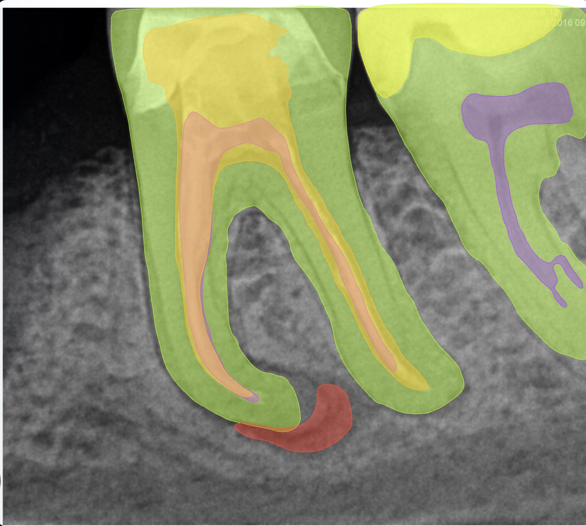 Intraoral